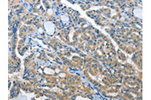The image on the left is immunohistochemistry of paraffin-embedded Human thyroid cancer tissue using ABIN7192019(PRKX Antibody) at dilution 1/15, on the right is treated with synthetic peptide. (PRKX 抗体)
