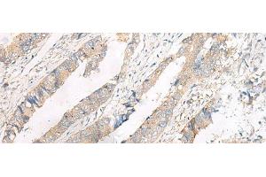 Immunohistochemistry of paraffin-embedded Human colorectal cancer tissue using FERD3L Polyclonal Antibody at dilution of 1:75(x200) (FERD3L 抗体)
