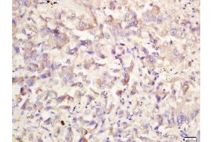 Formalin-fixed and paraffin embedded human lung carcinoma labeled with Rabbit Anti-ATG1/ULK1 Polyclonal Antibody, Unconjugated 1:200 followed by conjugation to the secondary antibody and DAB staining (ULK1 抗体  (AA 951-1050))