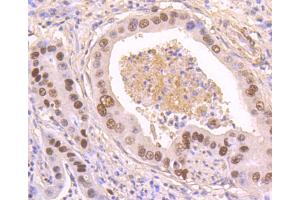 Paraformaldehyde-fixed, paraffin embedded human gastric cancer, Antigen retrieval by boiling in sodium citrate buffer (pH6) for 15min, Block endogenous peroxidase by 3% hydrogen peroxide for 30 minutes, Blocking buffer at 37°C for 20min, Antibody incubation with p53(S392) (3A1) Monoclonal Antibody at 1:50 overnight at 4°C, followed by a conjugated secondary and DAB staining. (p53 抗体  (pSer392))