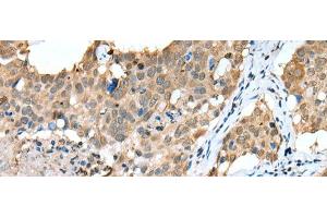 Immunohistochemistry of paraffin-embedded Human lung cancer tissue using SPRY4 Polyclonal Antibody at dilution of 1:25(x200) (SPRY4 抗体)