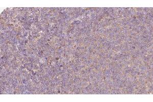 ABIN6273063 at 1/100 staining Human lymph cancer tissue by IHC-P.
