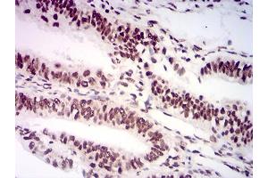 Immunohistochemical analysis of paraffin-embedded endometrial cancer tissues using AKT1S1 mouse mAb with DAB staining. (PRAS40 抗体  (AA 92-276))