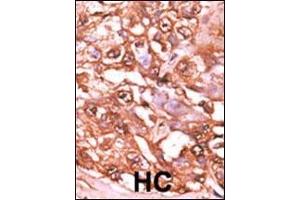 Formalin-fixed and paraffin-embedded human cancer tissue reacted with the primary antibody, which was peroxidase-conjugated to the secondary antibody, followed by AEC staining. (STAT5A 抗体  (pSer726))