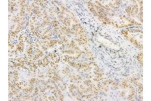 ABIN6255528 and ABIN6268985 at 1/100 staining human lung adenocarcinoma by IHC-P.