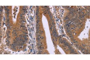 Immunohistochemistry of paraffin-embedded Human colon cancer using CMTM6 Polyclonal Antibody at dilution of 1:30 (CMTM6 抗体)