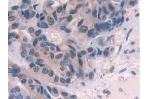 Detection of ENG in Human Breast cancer Tissue using Polyclonal Antibody to Endoglin (ENG) (Endoglin 抗体  (AA 26-136))
