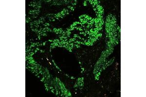 IF analysis of CTBP2 using anti-CTBP2 antibody (ABIN3042768) P-cadherin was detected in paraffin-embedded section of human colon cancer tissues. (CTBP2 抗体  (AA 321-445))