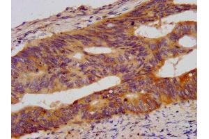 IHC image of ABIN7178015 diluted at 1:500 and staining in paraffin-embedded human colon cancer performed on a Leica BondTM system. (WDR37 抗体  (AA 1-496))