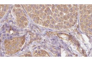 ABIN6273831 at 1/100 staining Human Melanoma tissue by IHC-P. (PAEP 抗体)