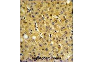 FBP1 Antibody (Center) (ABIN391577 and ABIN2841512) IHC analysis in formalin fixed and paraffin embedded human hepatocarcinoma followed by peroxidase conjugation of the secondary antibody and DAB staining. (FBP1 抗体  (AA 125-156))