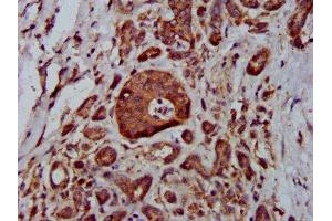 IHC image of ABIN7159086 diluted at 1:400 and staining in paraffin-embedded human pancreatic cancer performed on a Leica BondTM system. (MTBP 抗体  (AA 567-724))