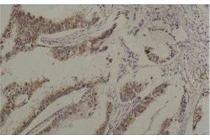 Immunohistochemistry of paraffin-embedded Human breast carcinoma tissue using HSPA8 Monoclonal Antibody at dilution of 1:200. (Hsc70 抗体)