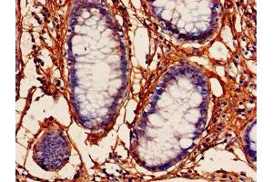 Immunohistochemistry of paraffin-embedded human colon cancer using ABIN7164219 at dilution of 1:100 (PFDN5 抗体  (AA 2-154))