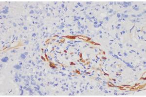 Immunohistochemistry of paraffin-embedded Human lung cancer using S100A7 Polycloanl Antibody at dilution of 1:200 (S100A7 抗体)