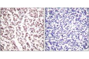 Immunohistochemistry analysis of paraffin-embedded human lymph node tissue, using Bloom Syndrome (Ab-99) Antibody. (Bloom Syndrome (AA 65-114) 抗体)