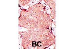 Formalin-fixed and paraffin-embedded human breast cancer tissue reacted with AK3L1 polyclonal antibody  , which was peroxidase-conjugated to the secondary antibody, followed by AEC staining. (AK4 抗体  (C-Term))