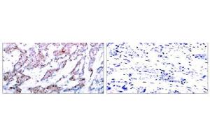 Immunohistochemical analysis of paraffin-embedded human breast carcinoma tissue using NF-κB p65 (phospho-Ser536) antibody (E011014). (NF-kB p65 抗体  (pSer536))