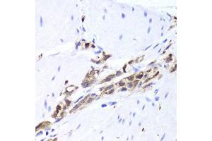 Immunohistochemistry of paraffin-embedded human gastric cancer using TPPP3 antibody. (TPPP3 抗体  (AA 1-176))