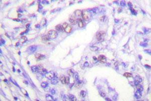 Immunohistochemical analysis of paraffin-embedded human lung cancer tissue using PIAS4 polyclonal antibody .