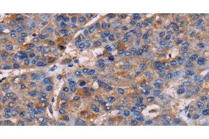 Immunohistochemistry of paraffin-embedded Human liver cancer using NPM3 Polyclonal Antibody at dilution of 1:60 (NPM3 抗体)