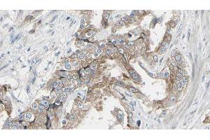 ABIN6278574 at 1/100 staining Human prostate tissue by IHC-P. (GIT1 抗体  (Internal Region))