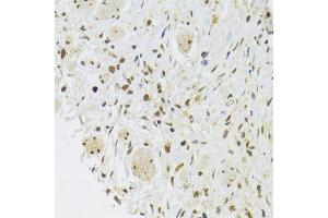 Immunohistochemistry of paraffin-embedded human gastric cancer using EFTUD2 Antibody (ABIN5974236) at dilution of 1/100 (40x lens). (EFTUD2 抗体)
