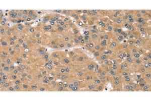 Immunohistochemistry of paraffin-embedded Human liver cancer tissue using RBM38 Polyclonal Antibody at dilution 1:45 (RBM38 抗体)
