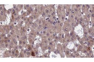 ABIN6277552 at 1/100 staining Human liver cancer tissue by IHC-P. (GFRA1 抗体  (Internal Region))
