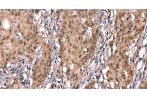 Immunohistochemistry of paraffin-embedded Human gasrtic cancer tissue using KCNJ6 Polyclonal Antibody at dilution 1:40 (KCNJ6 抗体)