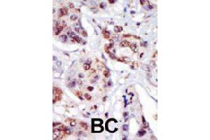 Formalin-fixed and paraffin-embedded human cancer tissue reacted with PIP4K2C polyclonal antibody  , which was peroxidase-conjugated to the secondary antibody, followed by AEC staining. (PIP4K2C 抗体  (C-Term))