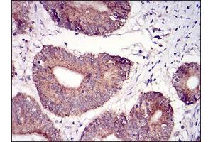 Immunohistochemical analysis of paraffin-embedded colon cancer tissues using TUBE1 mouse mAb with DAB staining. (TUBE1 抗体  (AA 314-472))