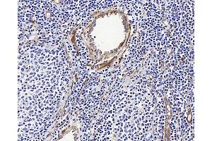 Immunohistochemistry analysis of paraffin-embedded human Lymphoma using LDLR Polyclonal Antibody at dilution of 1:300. (LDLR 抗体)
