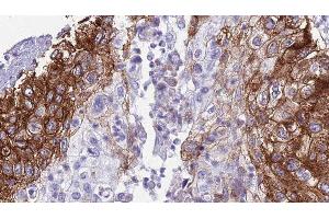 ABIN6276730 at 1/100 staining Human urothelial cancer tissue by IHC-P. (IL-6 Receptor 抗体  (N-Term))