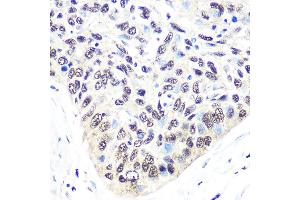 Immunohistochemistry of paraffin-embedded human esophageal cancer using Exportin 5 (XPO5) (XPO5) Rabbit mAb (ABIN1682763, ABIN3018126, ABIN3018127 and ABIN7101577) at dilution of 1:100 (40x lens). (XPO5 抗体)