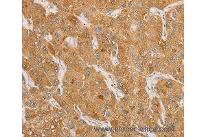 Immunohistochemistry of Human thyroid cancer using NGF Polyclonal Antibody at dilution of 1:50 (Nerve Growth Factor 抗体)