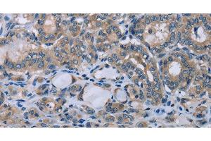 Immunohistochemistry of paraffin-embedded Human thyroid cancer using HOMER1 Polyclonal Antibody at dilution of 1:50 (HOMER1 抗体)
