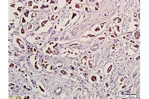 Formalin-fixed and paraffin embedded human breast cancer labeled with Anti-Ubiquitin/UBC/UB Polyclonal Antibody, Unconjugated (ABIN731183) followed by conjugation to the secondary antibody and DAB staining (Ubiquitin 抗体  (AA 1-76))