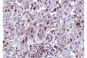 ABIN6272864 at 1/100 staining human lung carcinoma tissue sections by IHC-P. (METTL3 抗体)