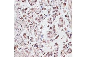 Immunohistochemistry of paraffin-embedded human lung cancer using DKC1 antibody (ABIN6127762, ABIN6139635, ABIN6139636 and ABIN6216722) at dilution of 1:100 (40x lens). (DKC1 抗体  (AA 1-180))