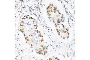 Immunohistochemistry of paraffin-embedded human gastric cancer using KPNA4 Antibody (ABIN5971058) at dilution of 1/200 (40x lens). (KPNA4 抗体)