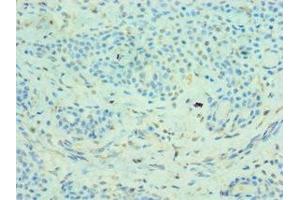 Immunohistochemistry of paraffin-embedded human breast cancer using ABIN7159067 at dilution of 1:100 (MMP14 抗体  (AA 260-540))