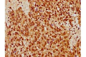 IHC image of ABIN7170790 diluted at 1:500 and staining in paraffin-embedded human ovarian cancer performed on a Leica BondTM system. (STRA8 抗体  (AA 115-241))