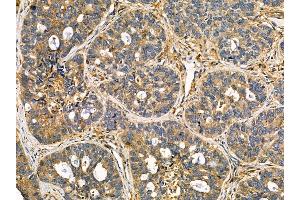 ABIN7095555 and ABIN7099612 at 1/100 staining human breast cancer by IHC-P.