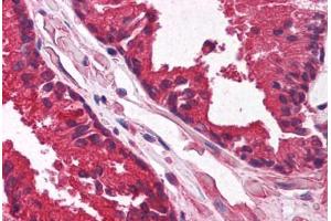 Human Prostate (formalin-fixed, paraffin-embedded) stained with KLF6 antibody ABIN214122 at 5 ug/ml followed by biotinylated goat anti-rabbit IgG secondary antibody ABIN481713, alkaline phosphatase-streptavidin and chromogen. (KLF6 抗体  (AA 155-204))