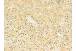 ABIN6262143 and ABIN6279389 at 1/100 staining human hepatocellular carcinoma by IHC-P.