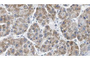 ABIN6269344 at 1/100 staining Human liver cancer tissue by IHC-P. (PAK1 抗体  (Internal Region))
