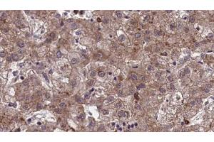 ABIN6273969 at 1/100 staining Human liver cancer tissue by IHC-P. (OR1J1 抗体)
