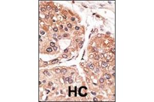 Formalin-fixed and paraffin-embedded human cancer tissue reacted with the primary antibody, which was peroxidase-conjugated to the secondary antibody, followed by DAB staining. (SMYD5 抗体  (C-Term))