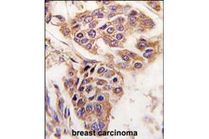Formalin-fixed and paraffin-embedded human breast carcinoma tissue reacted with C8orf32 antibody , which was peroxidase-conjugated to the secondary antibody, followed by DAB staining. (WDYHV1 抗体  (AA 106-136))
